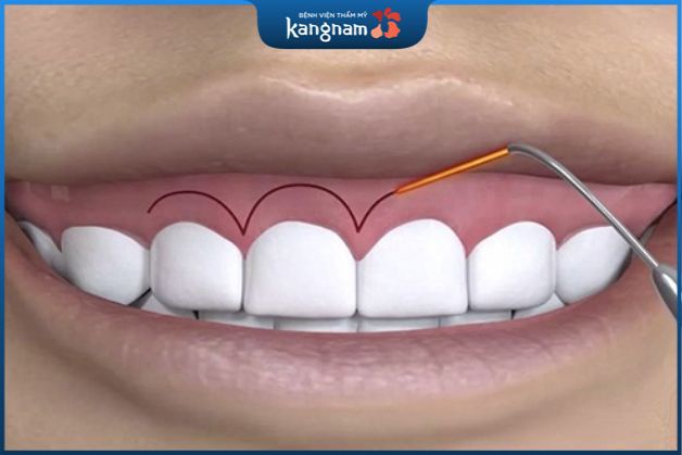 Phương pháp phẫu thuật điều trị cười hở lợi