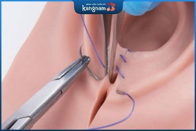 Phương pháp phẫu thuật giúp tạo hình vùng kín đẹp hoàn hảo hơn