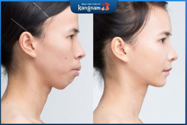 Chỉnh răng hô hàm trên