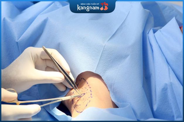 Cắt tuyến mồ hôi gây ảnh hưởng xấu nếu thực hiện ở nơi kém uy tín