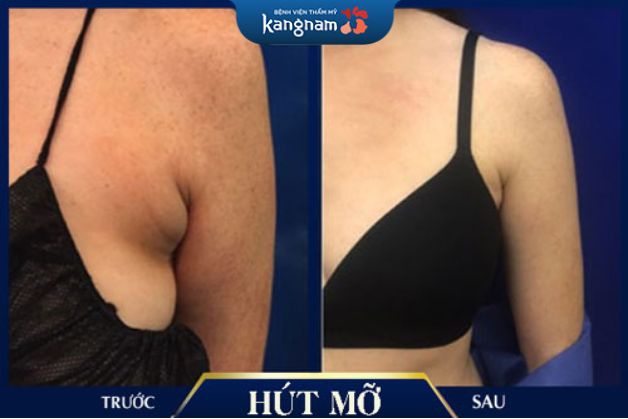 Hút mỡ Vaser Lipo trên cánh tay