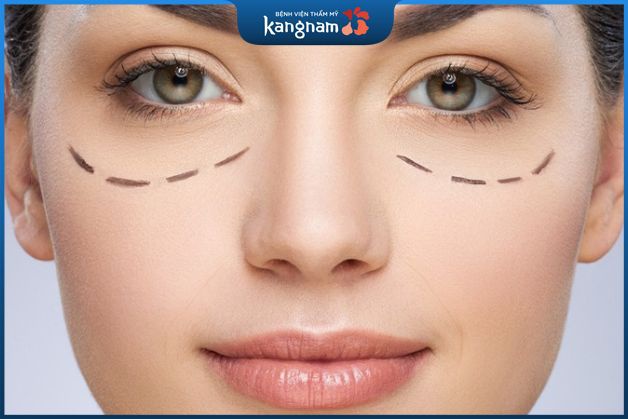 Sau khi cắt mí bao lâu thì được quan hệ?