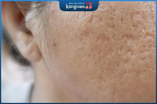 Sẹo đáy vuông ảnh hưởng lớn tới thẩm mỹ