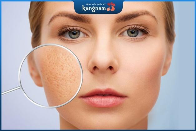 Sẹo lõm tồn tại lâu năm nếu chăm sóc không kỹ trong từng giai đoạn lành thương