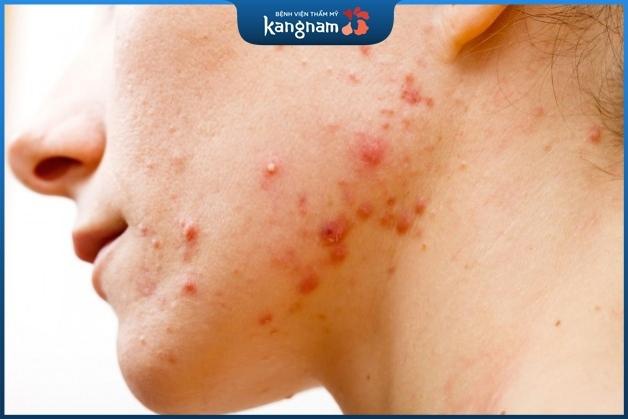 Sẹo rỗ hình thành do tổn thương sâu trên da