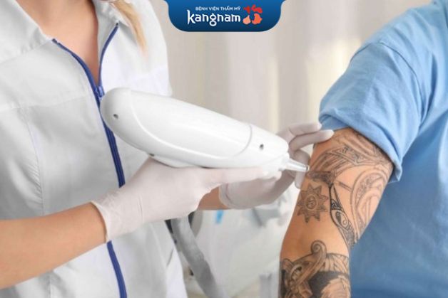 Sử dụng phương pháp ánh sáng xung cường độ cao xóa xăm