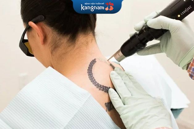 Áp lạnh xóa xăm cho hiệu quả cao