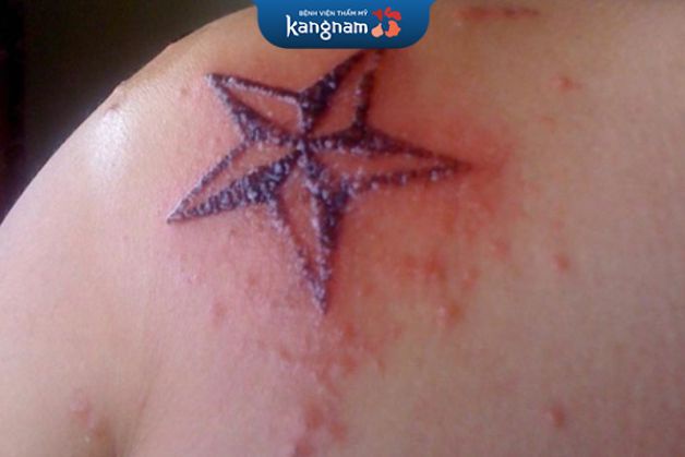 Biểu hiện sưng, đỏ sau khi xóa xăm