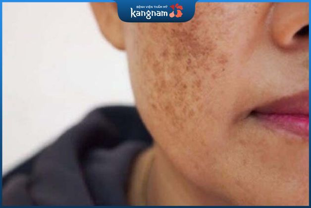 Da tàn nhang có ảnh hưởng đến sức khỏe không?