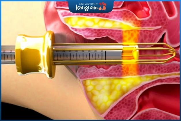 Thẩm mỹ vùng kín bằng laser đem lại hiệu quả nhanh