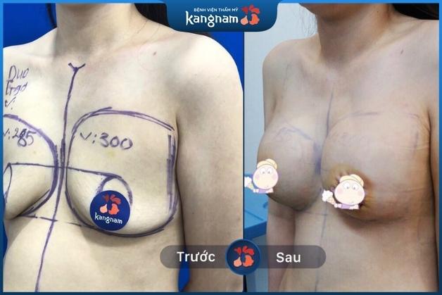 Treo ngực sa trễ tại Kangnam