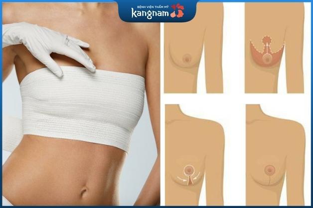 Thu nhỏ ngực sa trễ không gây đau đớn quá nhiều