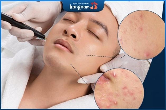 Chữa mụn bằng laser tốt nếu quy trình đảm bảo