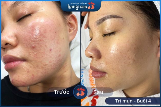 Trị tận gốc mọi loại mụn