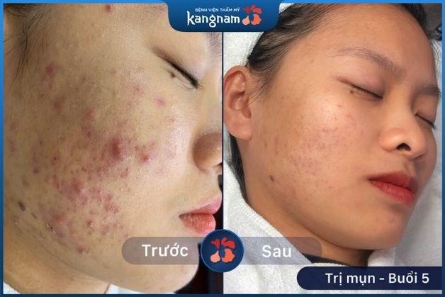 Trị mụn thâm đỏ tại Kangnam
