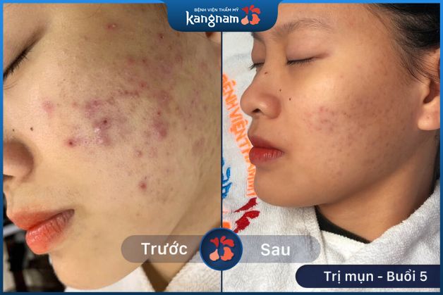 Mụn nhọt, mụn viêm được điều trị hiệu quả