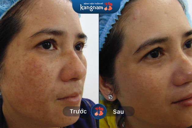 Da sáng mịn hơn nhờ sự tăng sinh collagen tự nhiên