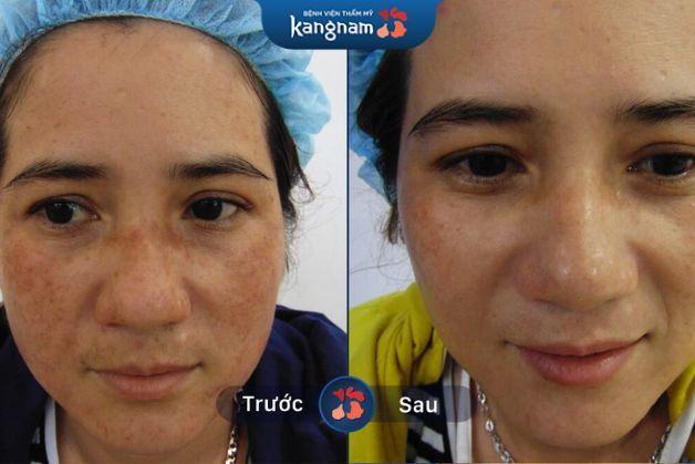 Xóa sạch nám lâu năm