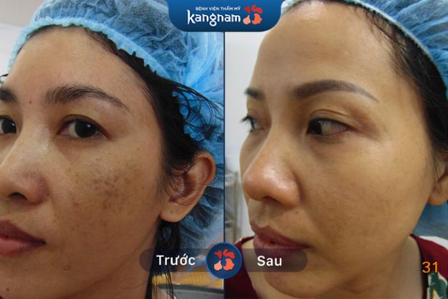 Xóa nám không để lại sẹo, thâm sạm