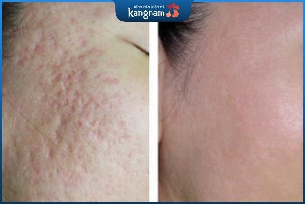 Trị sẹo lõm tại Kangnam