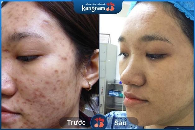 Trị sẹo vuông Kangnam