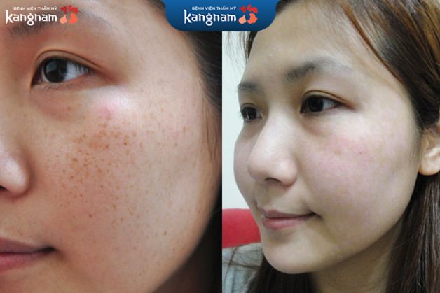 Loại bỏ tàn nhang cho da hiệu quả