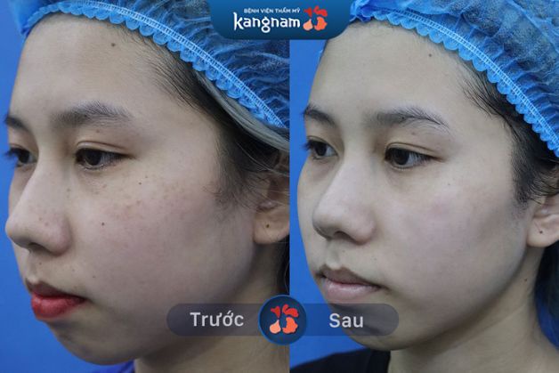Trị tàn nhang bằng Laser Picosure