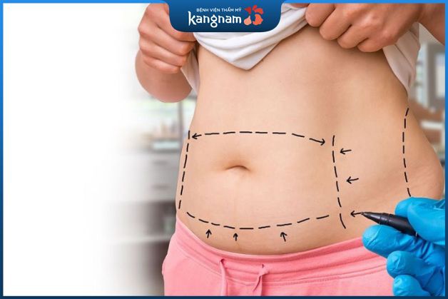 Ưu điểm nổi bật khi hút mỡ Vaser Lipo