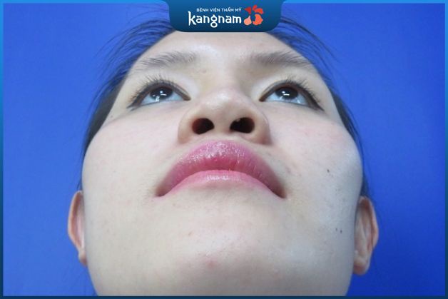 Vách ngăn mũi lệch xuất hiện khi nào?