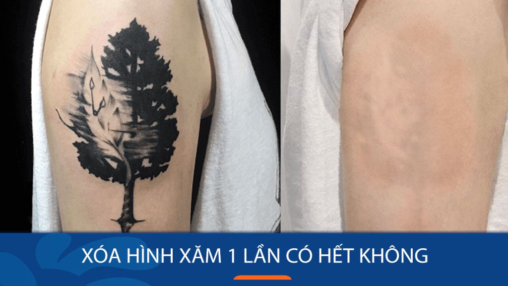 Xóa hình xăm 1 lần có hết không? Giải đáp từ chuyên gia