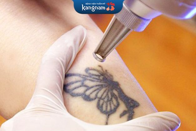 Công nghệ hiện đại có thể xóa bỏ hình xăm hoàn toàn