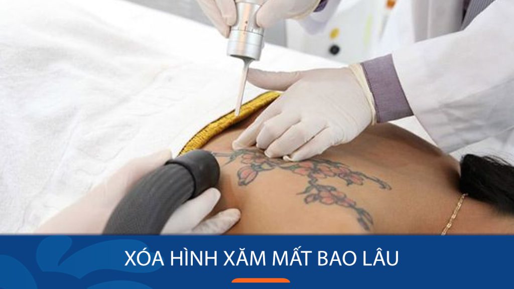 Xóa hình xăm mất bao lâu – Cách chăm sóc nhanh lành