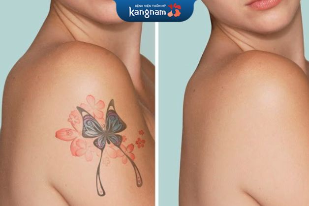 Xóa hình xăm cần từ 4-6 buổi