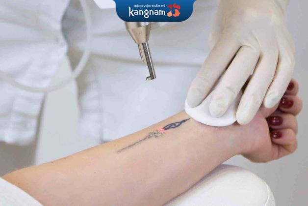 Tia laser xóa xăm ngày càng được ứng dụng nhiều