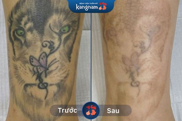 Xóa xăm không để lại sẹo xấu