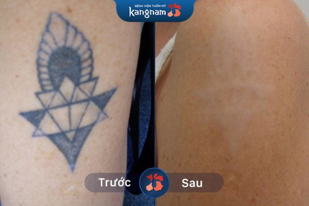 Xóa hình xăm mất bao lâu