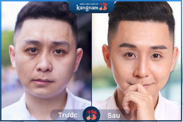 Phương pháp chỉnh sửa phù hợp sẽ đem lại kết quả thẩm mỹ cao mà không lo để lại sẹo