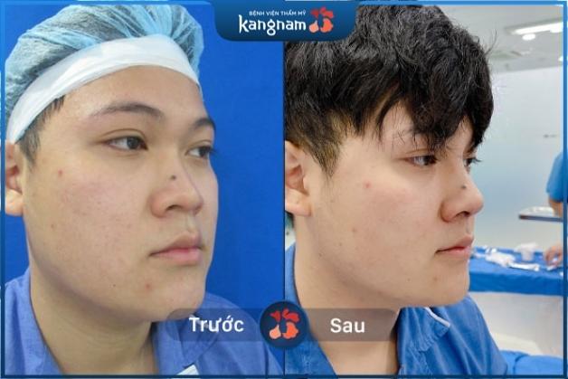 Trước: Mũi lệch sóng – Sau nâng mũi cấu trúc: Mũi thẳng đẹp tự nhiên