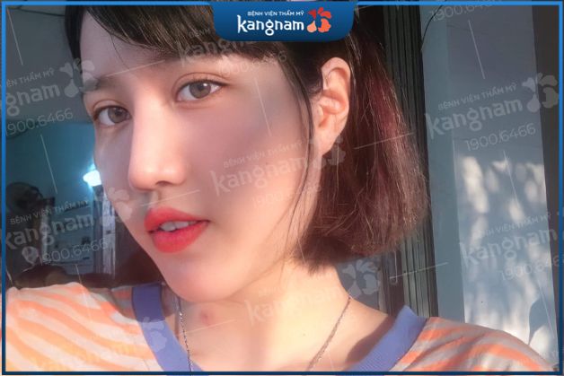 Sau cắt cánh mũi cần tuyệt đối kiêng các thực phẩm dễ gây sẹo