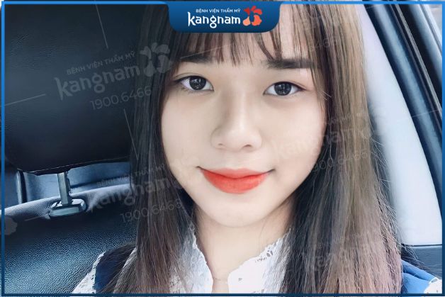 Nâng mũi S-Line 3D là giải pháp khắc phục mũi ngắn an toàn