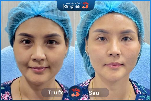 Căng da không can thiệp phẫu thuật, an toàn và hiệu quả cao