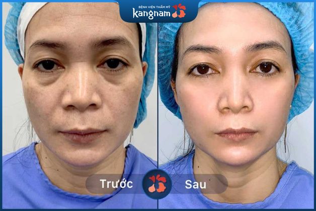 Da căng bóng giúp khách hàng trẻ ra 10 tuổi