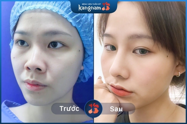 Sở hữu tướng mạo xinh đẹp hơn sau 60 phút cắt cánh mũi tại Kangnam