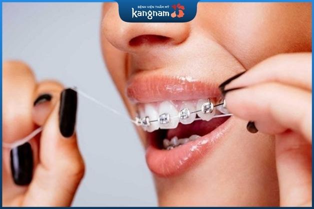 Chăm sóc răng miệng trong khi niềng răng là điều vô cùng cần thiết