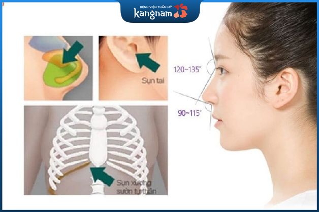 Chất liệu sụn tự thân