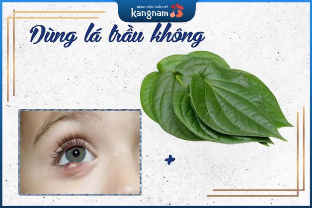 Mẹo khắc phục mắt bị mọc lẹo tại nhà