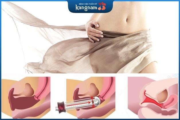 Cơ chế tác động của tia laser với thành âm đạo