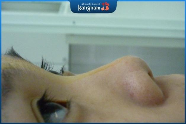 Những phương pháp nâng mũi thông thường có thể gây ra biến chứng