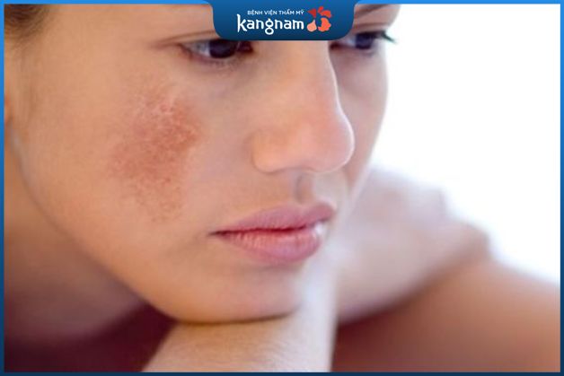 Dấu hiệu nhận biết nám da mặt