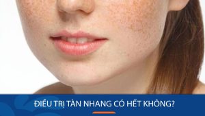 Điều trị tàn nhang có hết không? 3 Giải pháp điều trị tại Kangnam